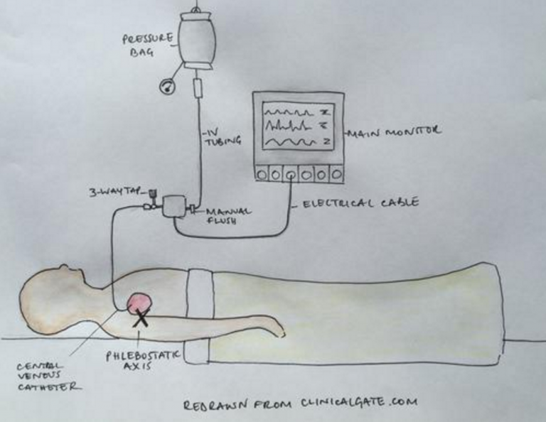 Central Venous Pressure (CVP)